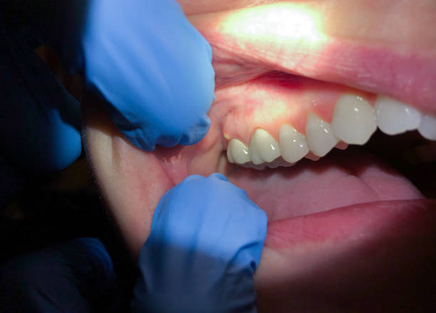 Best Emergency Root Canal Treatment in Seven Lakes, NC