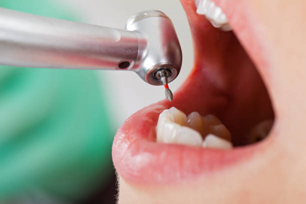 Best Emergency Dental Care for Broken or Chipped Teeth in Seven Lakes, NC